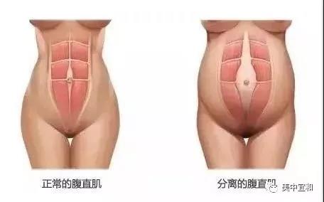 比起大肚腩、妊娠紋...，產后腹直肌分離更可怕！！