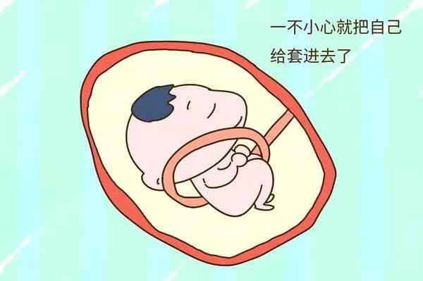臍帶繞頸就一定等著剖了嗎？