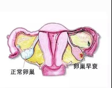女性出現卵巢早衰，究竟誰是元兇？