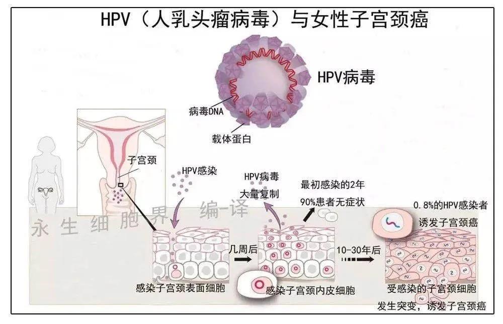HPV檢查呈陽(yáng)性，我是不是得宮頸癌了？