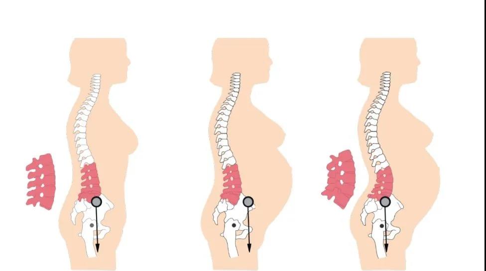 揭秘產后腰背痛：是誰動了我的小蠻腰？