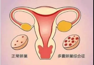 過度肥胖可能導致不孕不育 | 看優生優育專家怎么說？